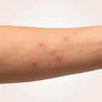 Болезни, укусы на теле